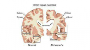malattia di alzheimer2